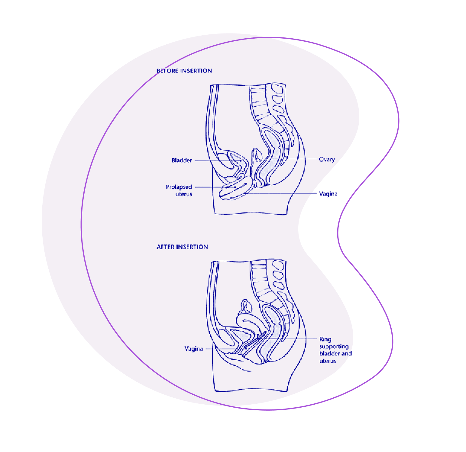 incontinence-and-prolapse-gynaecologist-consultant-london